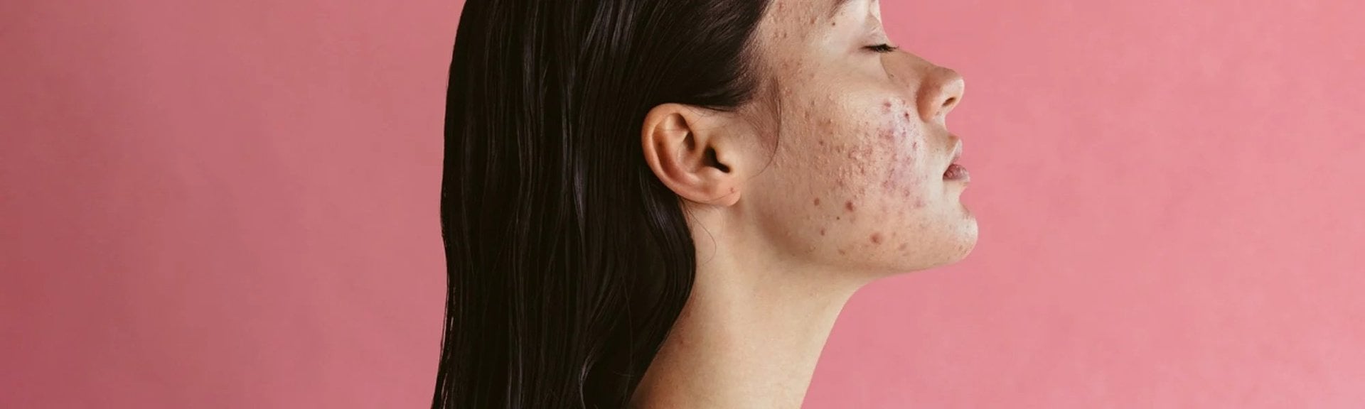 top-banner-acne-study